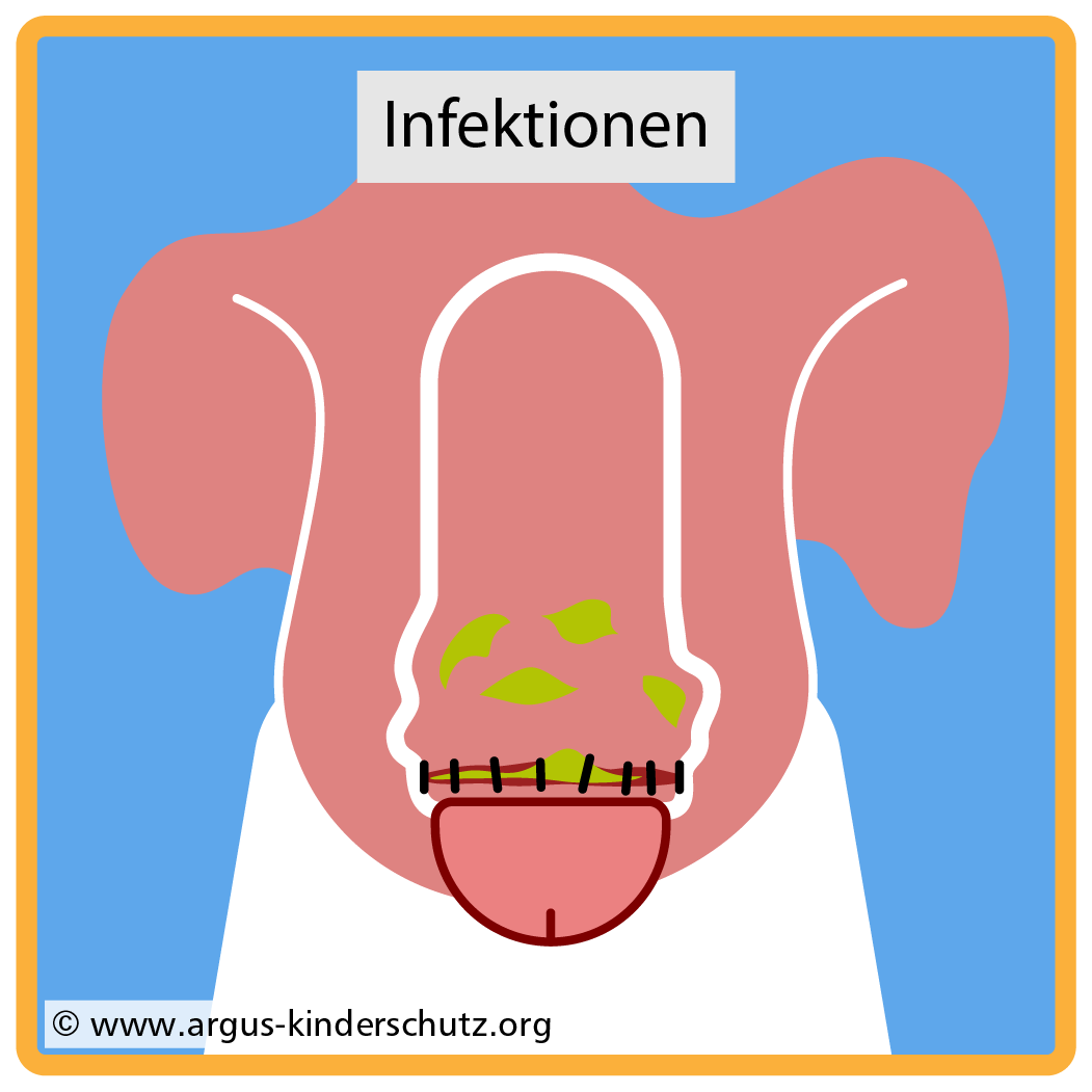 Icon Risiken der Beschneidung: Infektionen.
