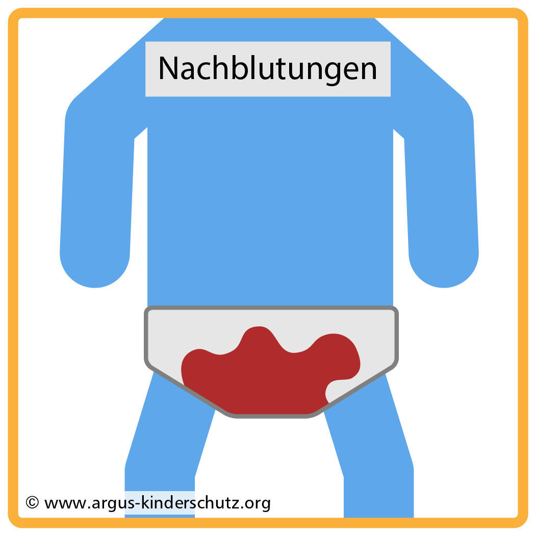 Icon Risiken der Beschneidung: Lebensbedrohliche Nachblutung.