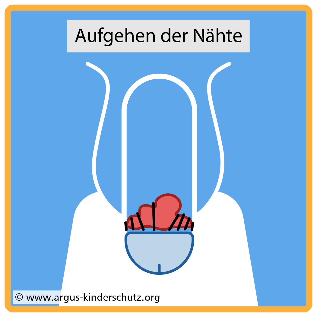 Icon für Risiken der Beschneidung: Nahtinsuffizienz.