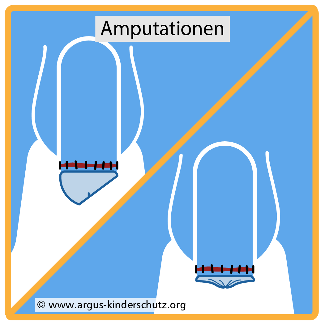 Icon Risiken der Beschneidung: Beschädigung und Amputation der Eichel.