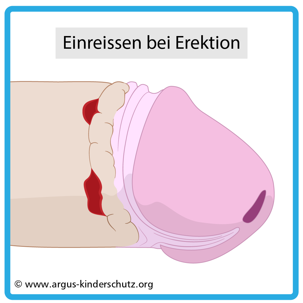 Zeichnung von Folgen von Beschneidung: Einreißen an der Narbe bei Erektion
