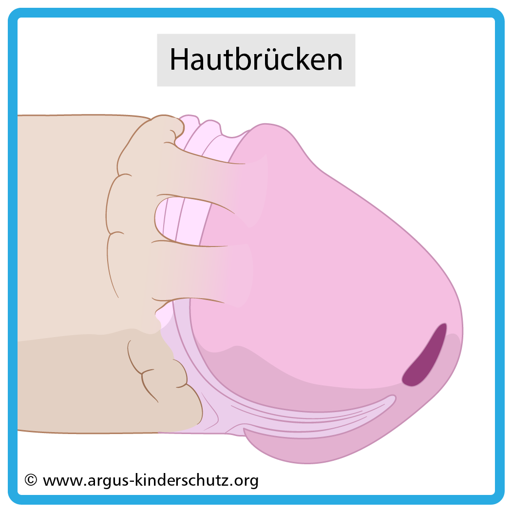Zeichnung von Folgen von Beschneidung: hatubrücken von Penis Schafthaut auf Eichel.
