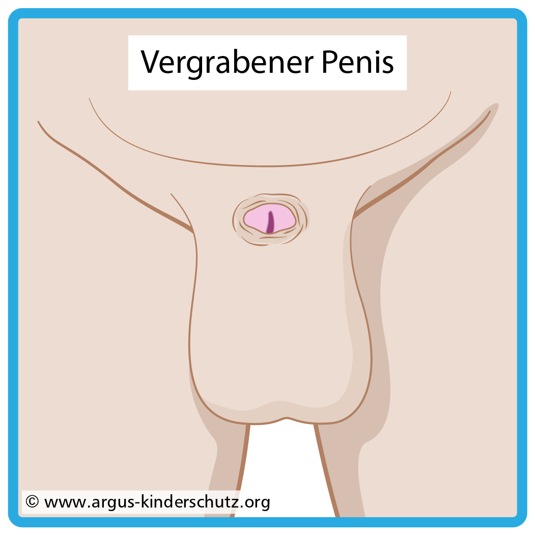 Zeichnung von Folgen von Beschneidung: Verborgener Penis